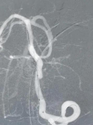 淄博市中心医院治疗动脉瘤,tubridge动脉瘤支架医保报销多少