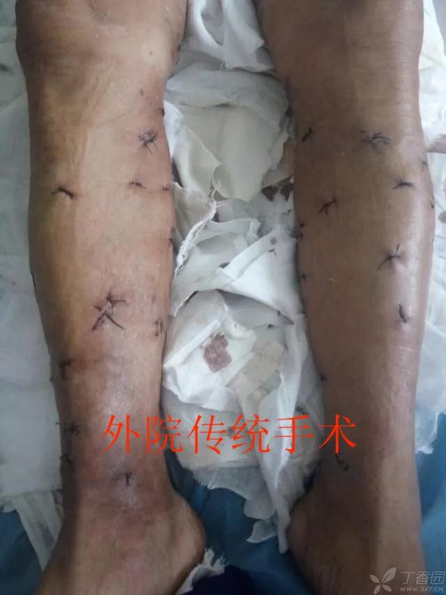 青岛第八人民医院义诊,山东青岛市立医院治疗静脉曲张