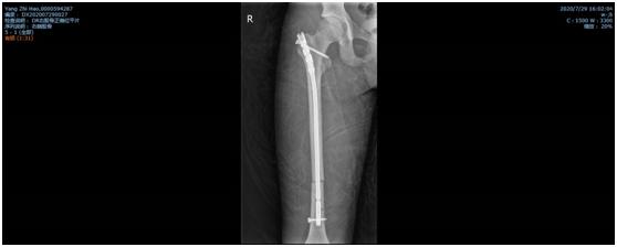 骨折一定要打石膏吗,骨折非要打钢钉吗