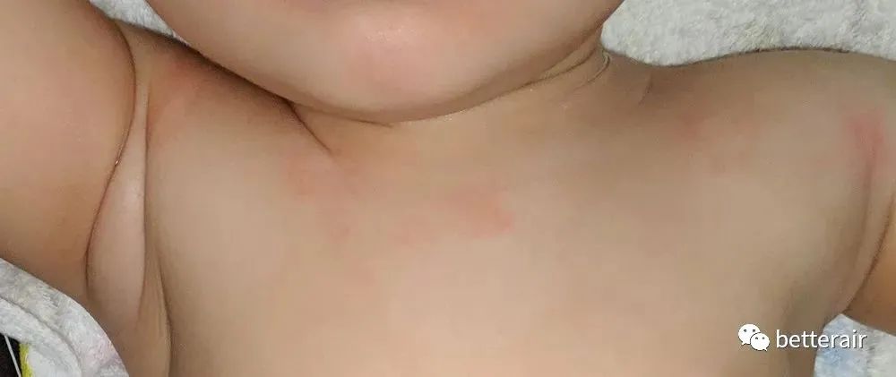 宝宝湿疹咳嗽流涕减轻,宝宝湿疹反复奇痒难忍