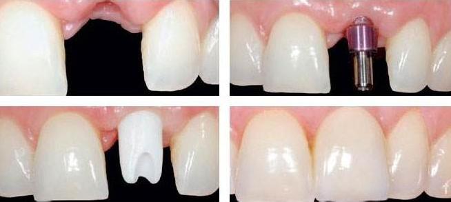 2000块的种植体你真的敢种吗?为什么会这么便宜,良心牙医告诉你