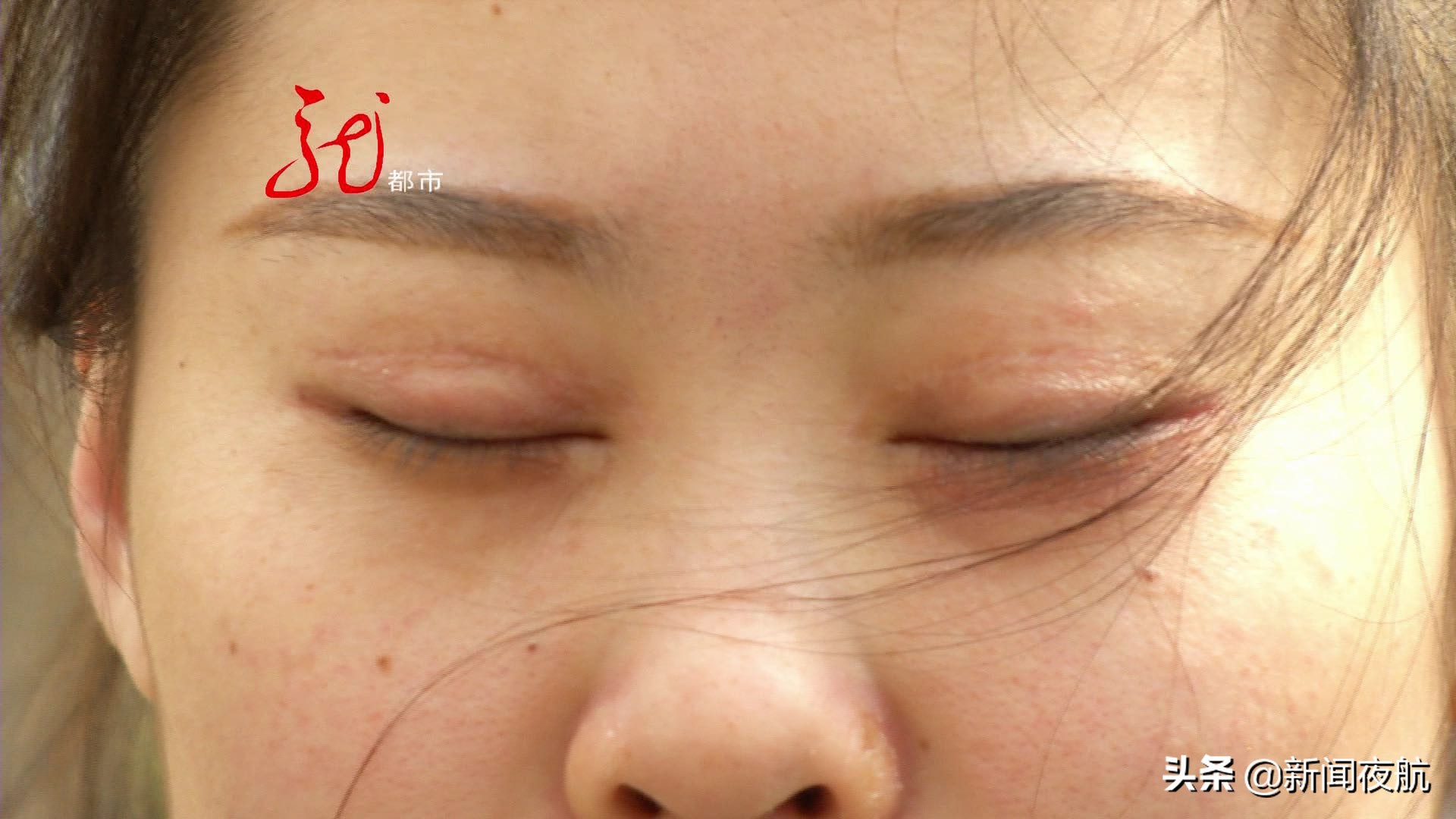 双眼皮手术半年了眼睛肿,双眼皮手术半年了还肿怎么办