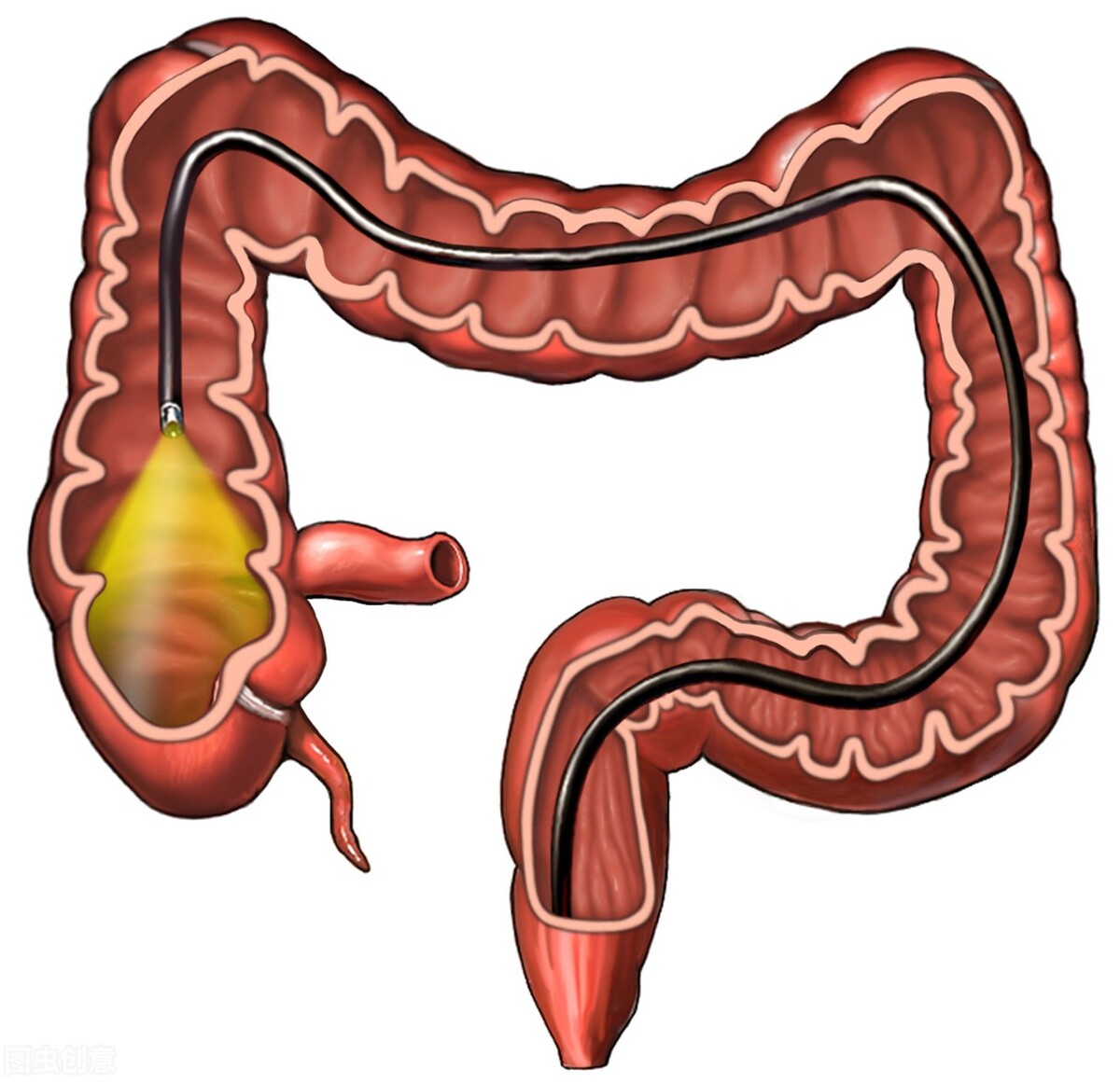 6mm的肠息肉一般要多少年长成,6mm肠息肉不切定期检查可以吗