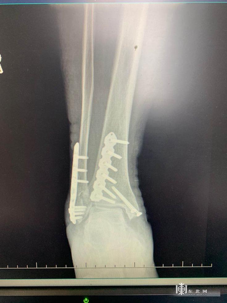 脚外踝骨折复查骨质疏松,三十多崴脚骨折是不是骨质疏松
