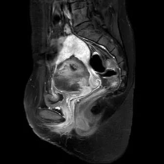 胎盘植入的海扶治疗：光和爱的到来让伤害更小