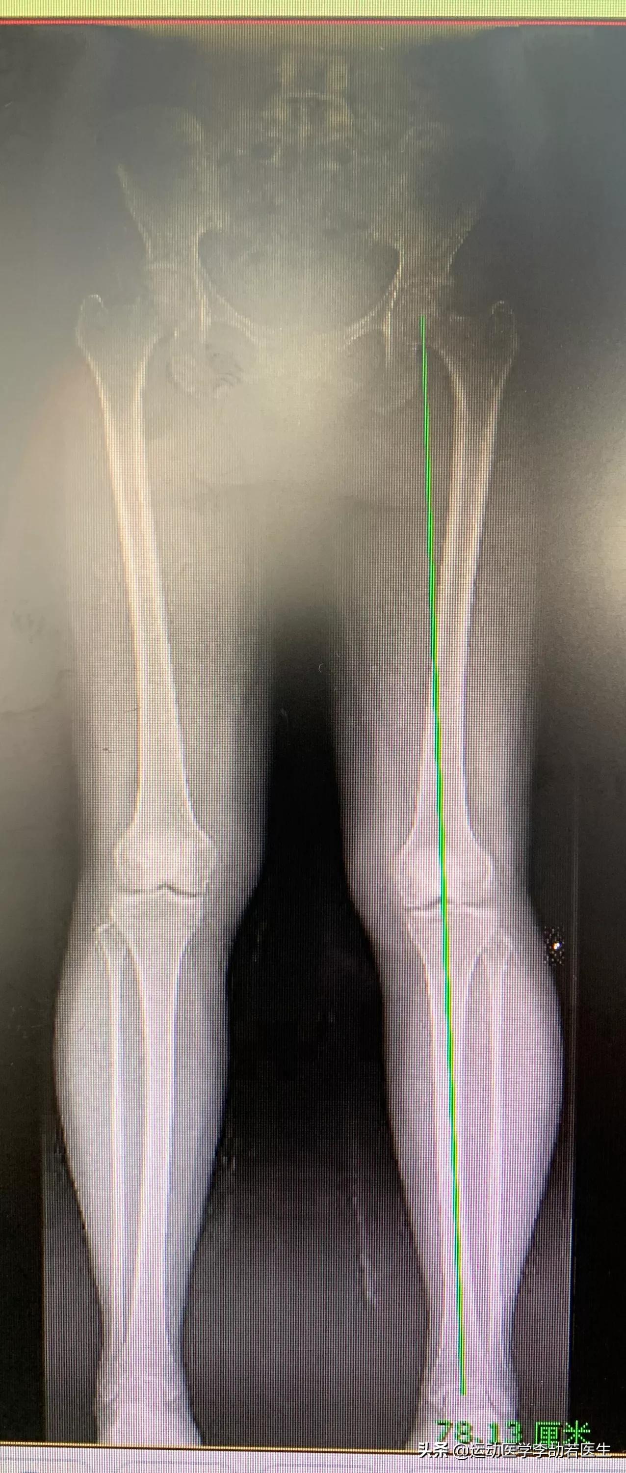 骨关节炎到底该怎么治,骨关节炎怎么治才能彻底治好