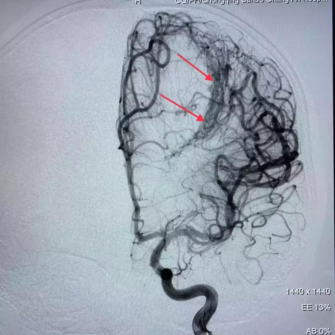 北京三博脑科医院康复治疗,北京三博脑科医院治脑血管瘤怎样