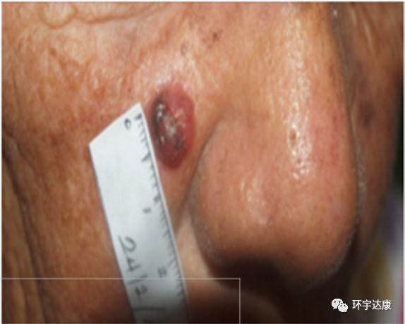 古巴癌症疫苗效果怎么样,古巴研究出癌细胞疫苗