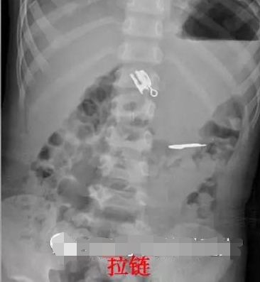 4岁男孩吞2cm钉子,4岁男孩吞下一颗5厘米钢钉