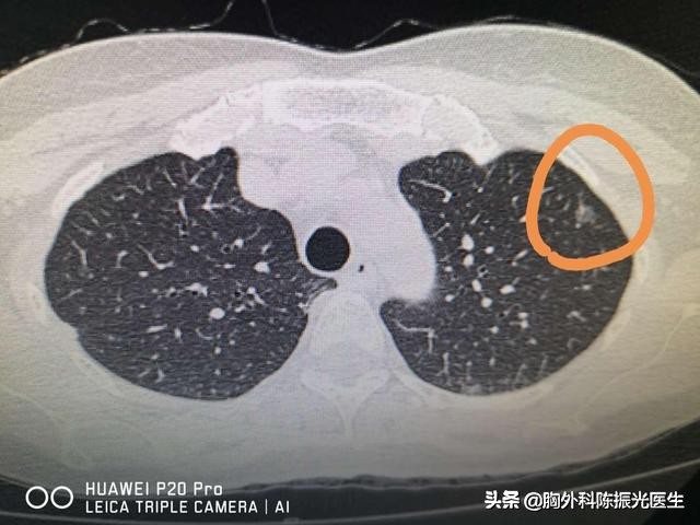 长期观察不变的肺结节是肺癌吗,肺结节观察几年基本就没有变化了