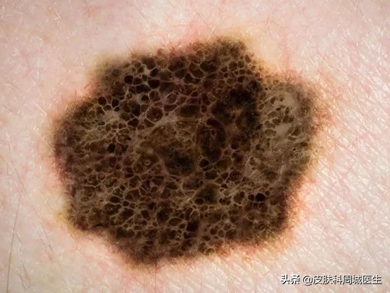 皮肤科什么肿瘤恶性高,皮肤恶性黑色素瘤是癌吗