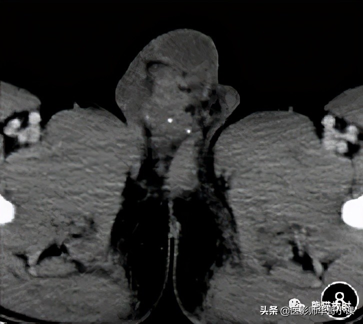 [精品课件]畸胎瘤及精原细胞瘤（*丸睾**肿瘤及肿瘤样变CT及MR表现）
