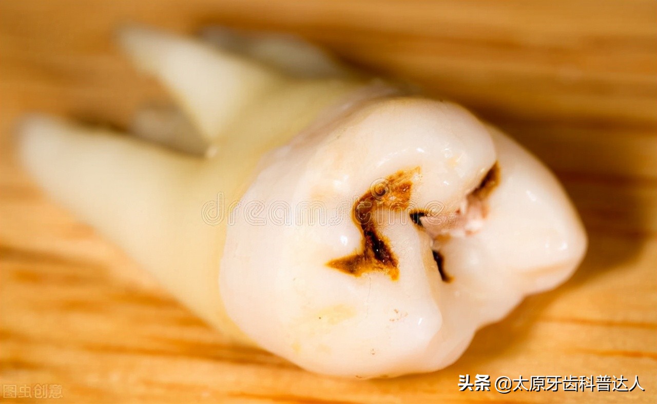 牙齿龋坏不痛可以不做根管,龋坏的牙齿自己掉后能补吗