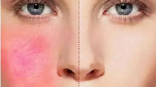 油敏干敏是什么症状,如何区别干敏和油敏