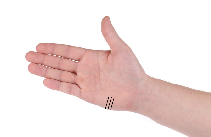 左手大拇指指甲上有褐色的竖纹,指甲上有竖纹代表有糖尿病吗