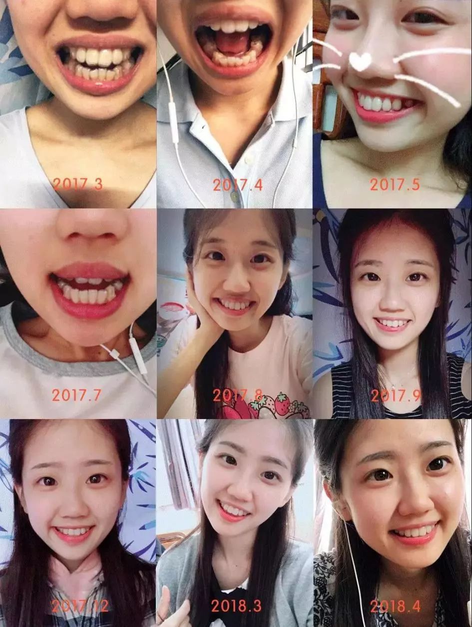 国家有关于牙齿的补贴吗,牙齿补贴报销政策