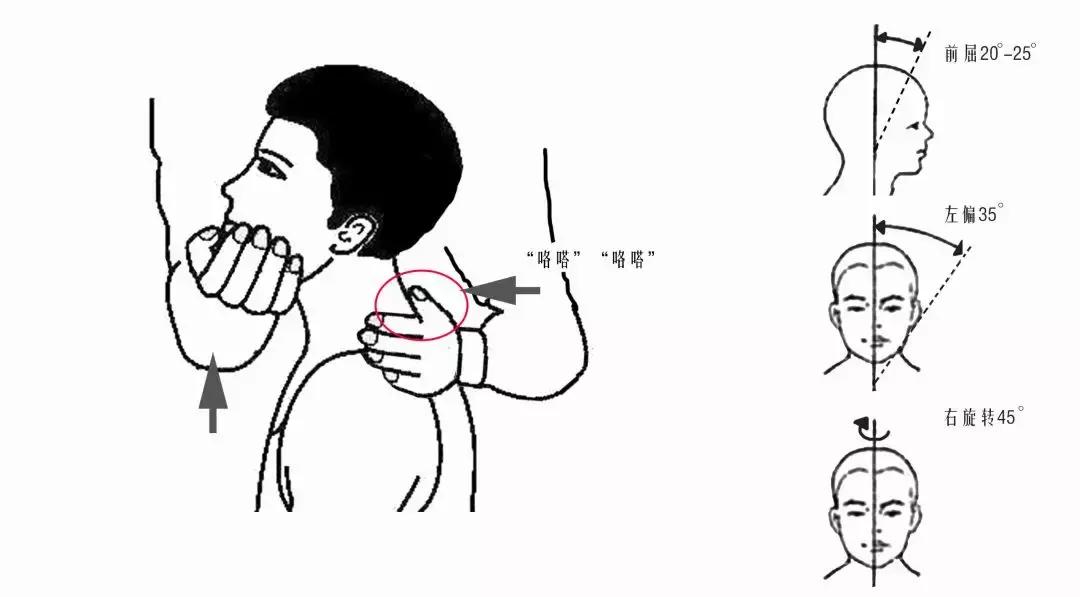 颈椎腰腿痛针刀,针刀颈椎病