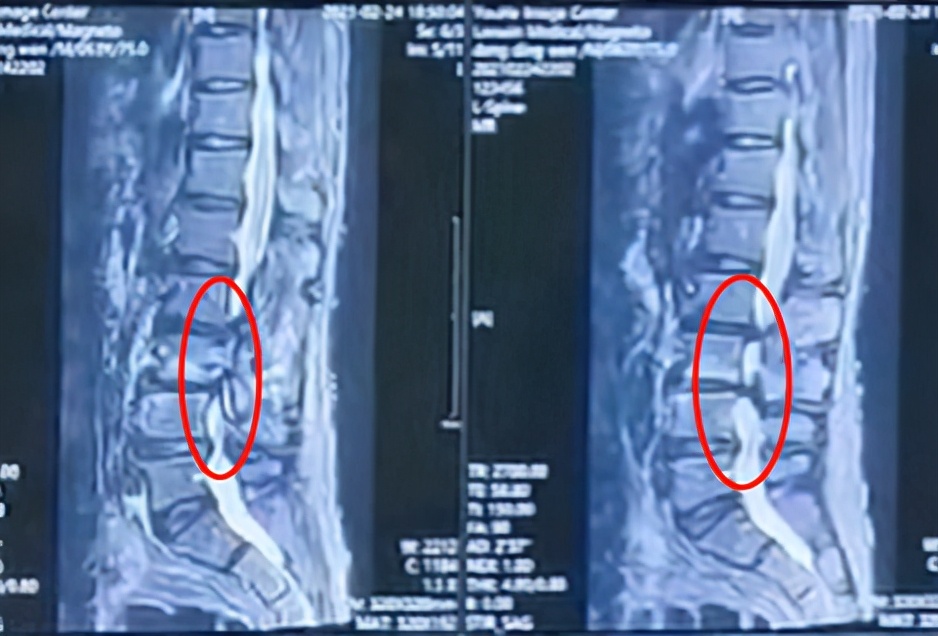 腰椎退变侧弯是什么意思,年轻人腰椎退行性改变是怎么回事