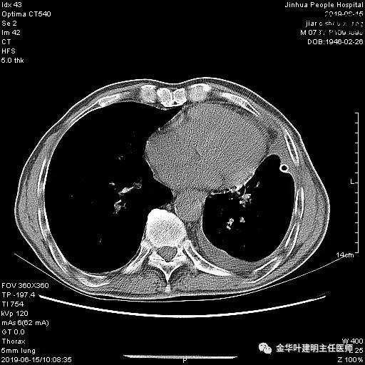 手术引起乳糜胸,有没有做了肺结节手术后是误诊的
