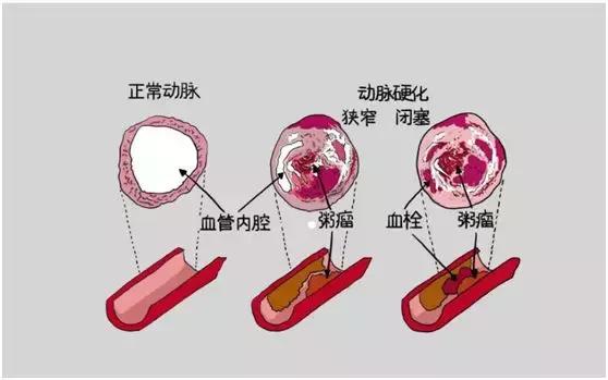 心脏支架将被新技术取代,支架国外淘汰了吗