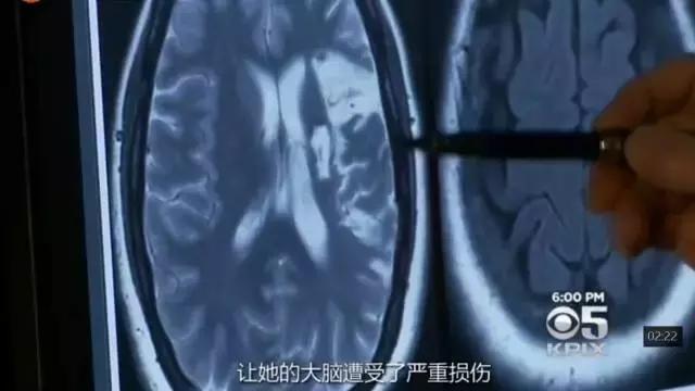 2021干细胞治疗脑卒中,2025年中国干细胞治疗