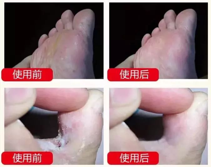 冬天脚后跟干裂用什么润脚霜,润足脚后跟干裂修复霜