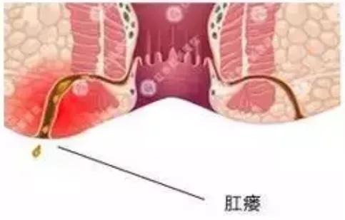 小儿肛瘘五年没复发是自愈了吗,肛瘘每天用高锰酸钾坐浴能自愈吗