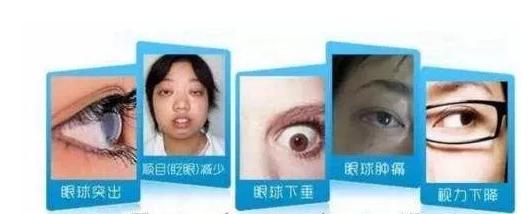 甲亢突眼该如何治疗最好,甲亢突眼该怎么治疗好的快些