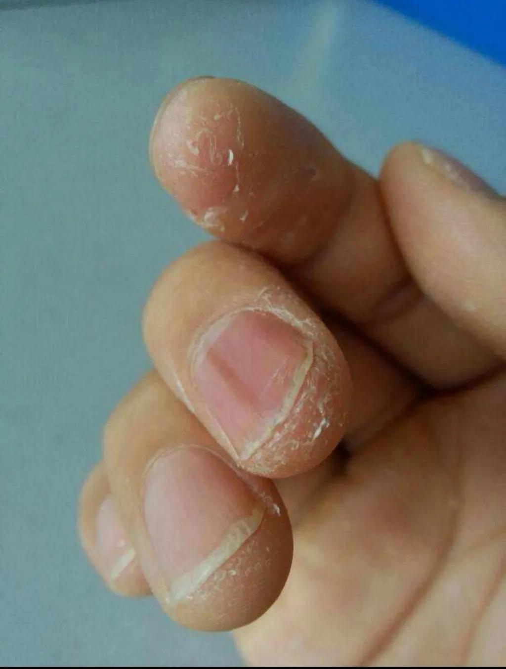 专家教你正确剪指甲的方式,正常指甲怎么修剪为健康