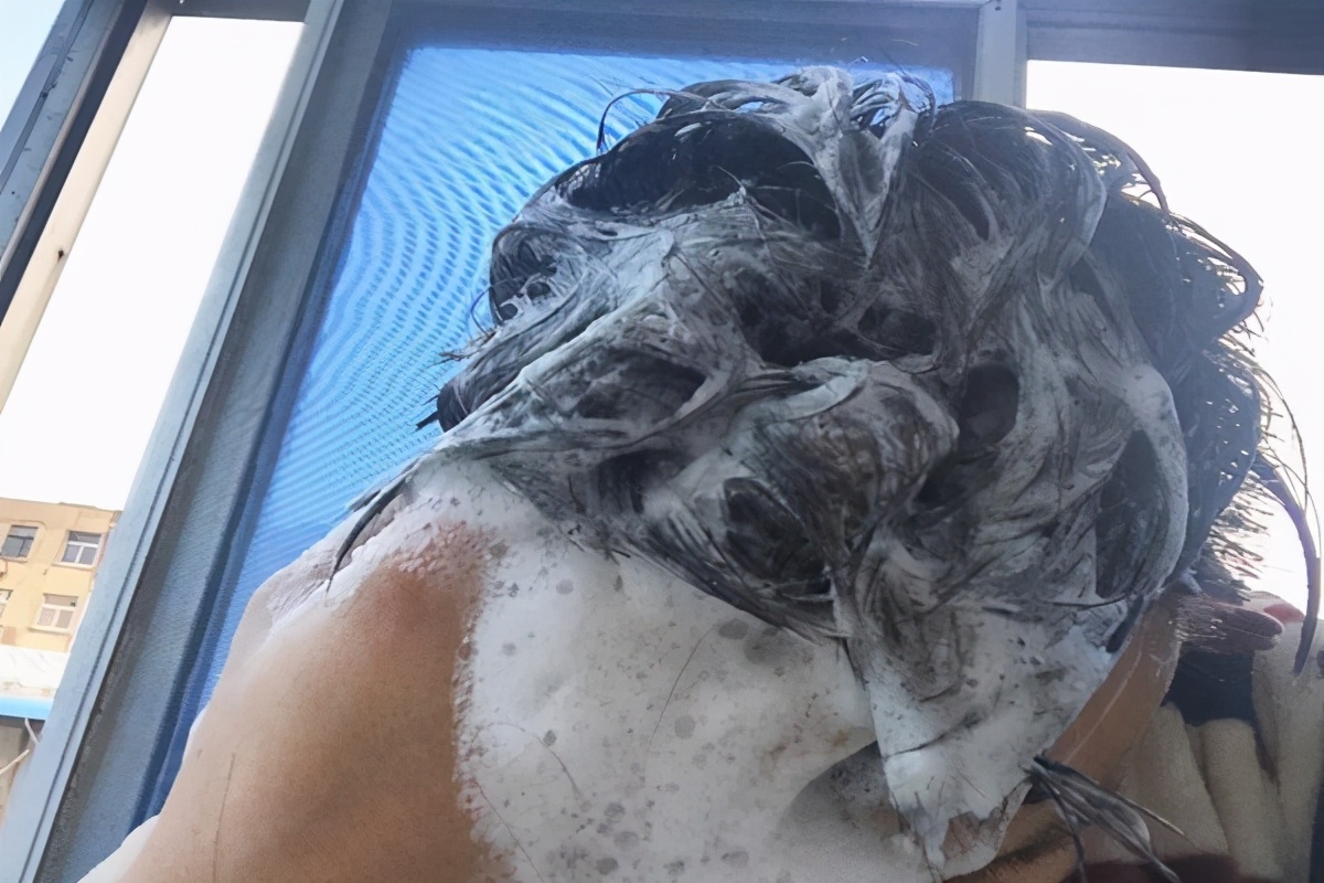 如何去除大块头皮屑你有哪些经验,偶尔头皮屑多怎么去除最简单方法