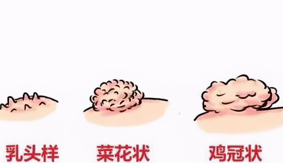 被hpv病毒感染了身上的皮肤会痒吗,hpv病毒是血液里面还是皮肤表面