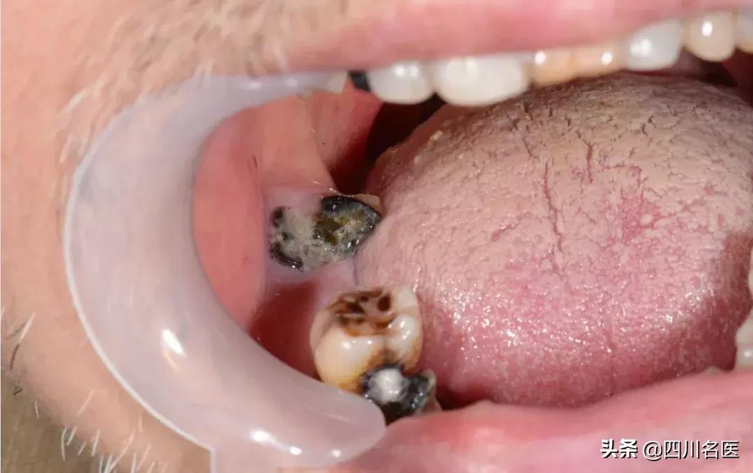 口腔溃疡喝酒变成口腔癌,口腔溃疡频繁发作是不是口腔癌