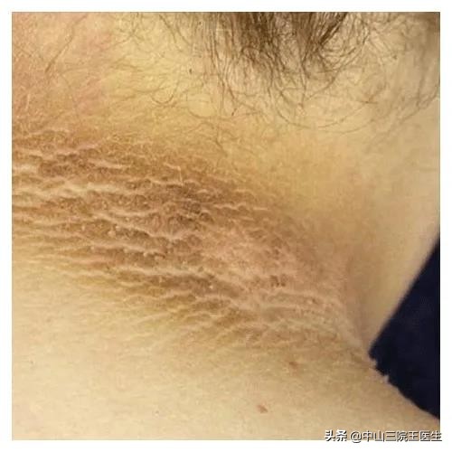 黑棘皮病怎样快速去除,如何有效快速去除黑棘皮病