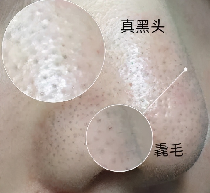 消灭黑头，男女都一样，颜值加倍