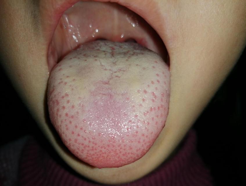 幼儿积食口臭怎么调理,幼儿积食口臭放屁臭吃什么药调理