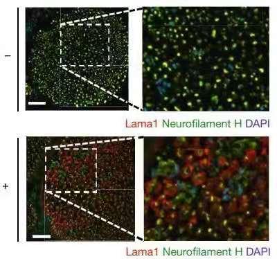 缺乏型肌营养不良,不是营养过剩而是营养失衡