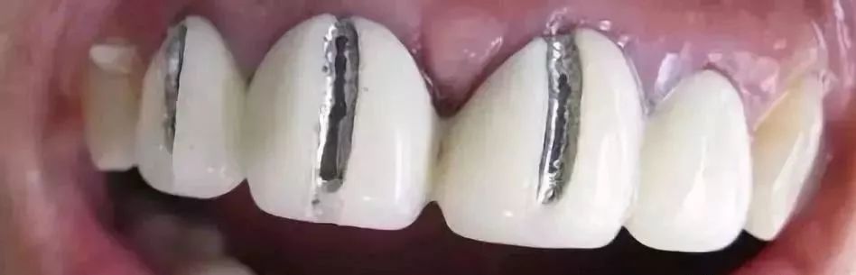 烤瓷牙做什么样的性价比高,沈阳烤瓷牙哪家便宜又好