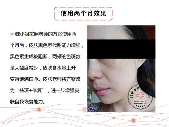 孕妇长斑修护产品,孕妇长斑怎么办用什么可以祛斑