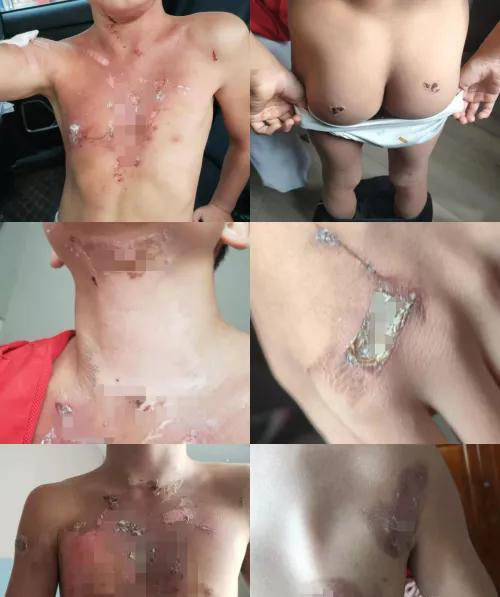 被开水烫到6岁小男孩,少年被热油烫伤后续
