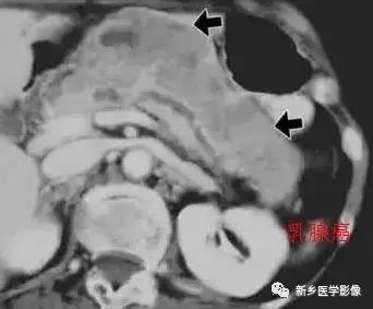 18种胰腺肿瘤，为什么我就知道两种