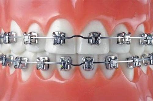 小伙相亲被弃，“大凸牙，我不要嫁给你”快三十，矫正还来得及？