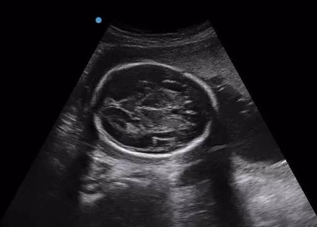 孕期吃什么胎儿头会大,孕妈胎儿头大怎么办