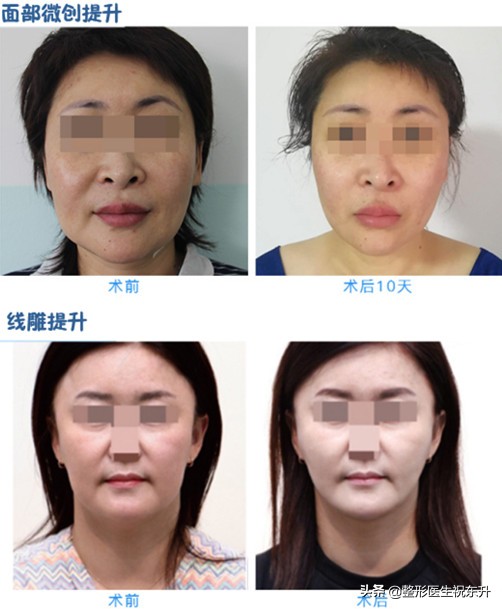 法令纹不做医美可以去除吗,祛除法令纹做什么手术效果好