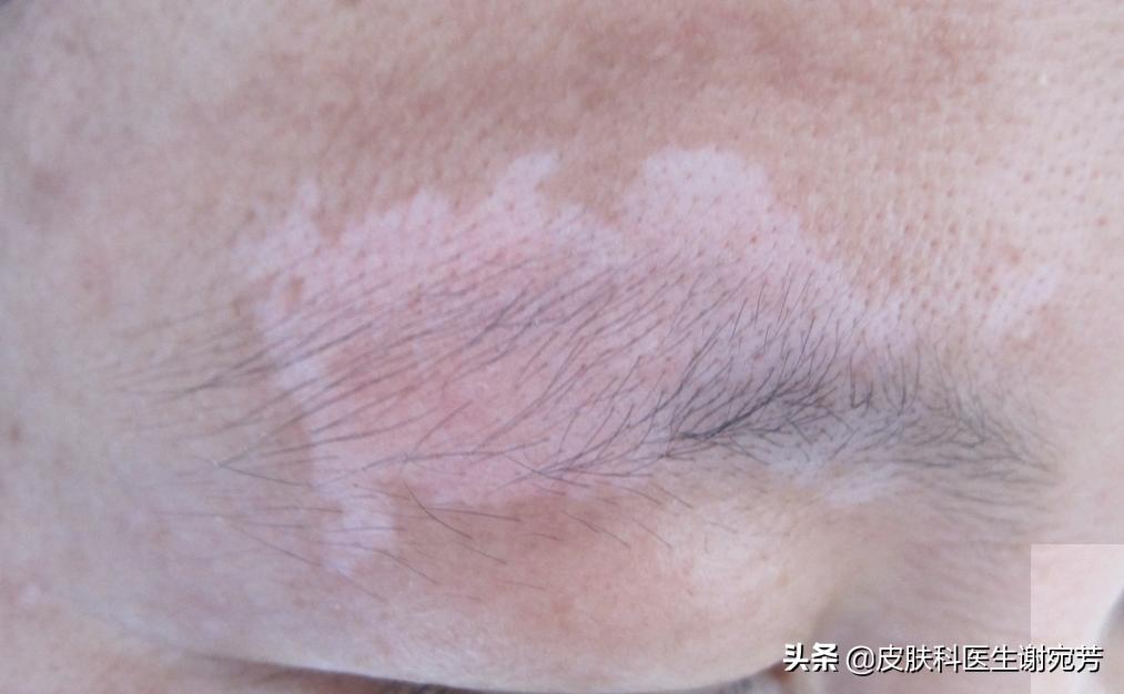 花斑癣白斑和白癜风白斑的区别,长了白斑能自愈是白癜风吗