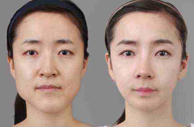 打了瘦脸针老了会变成什么样,打瘦脸针10天后变化图