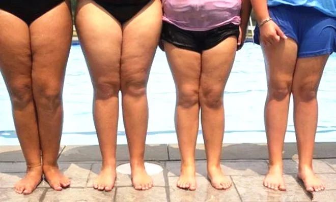 大腿太粗走路内侧磨红怎么办,大腿内侧磨腿怎么解决