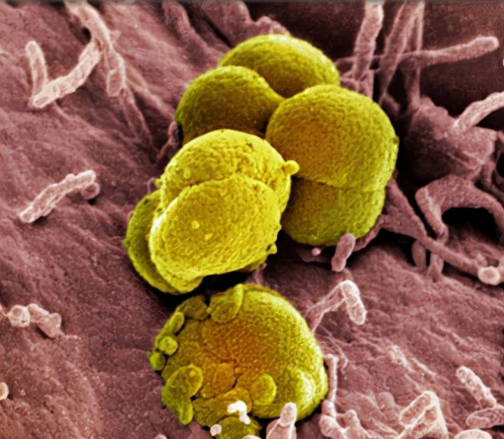 男性尖锐性湿疣患病原因,男生得了尖锐性湿疣最好的办法