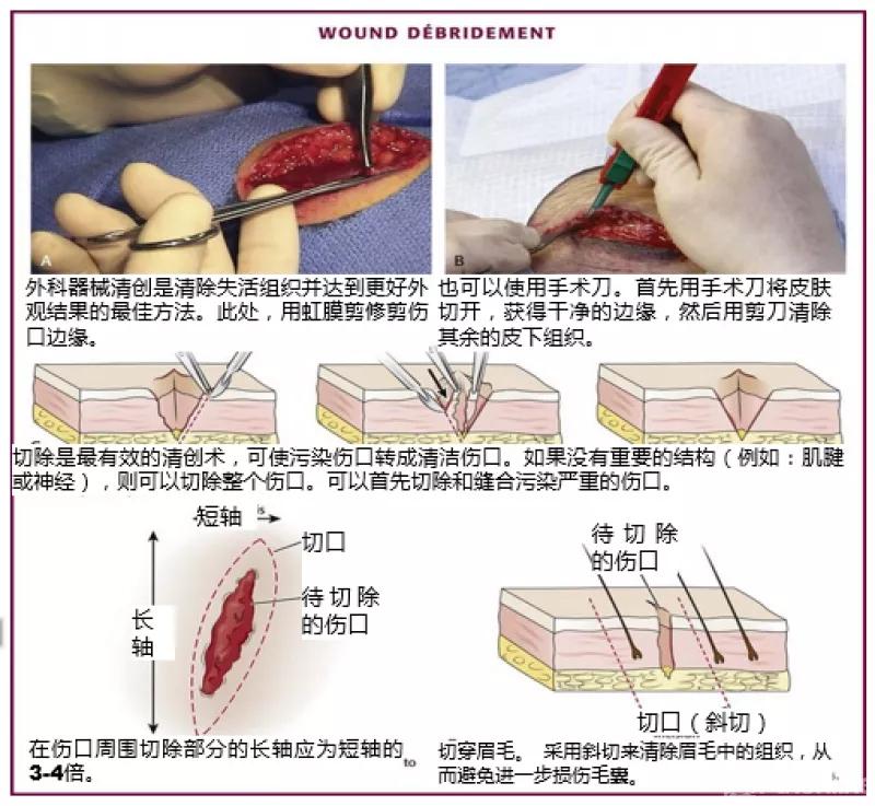 临床清创原则,临床清创