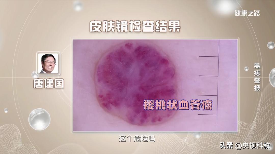 黑痣很容易恶变吗,身上黑痣出现什么状况有癌变发生