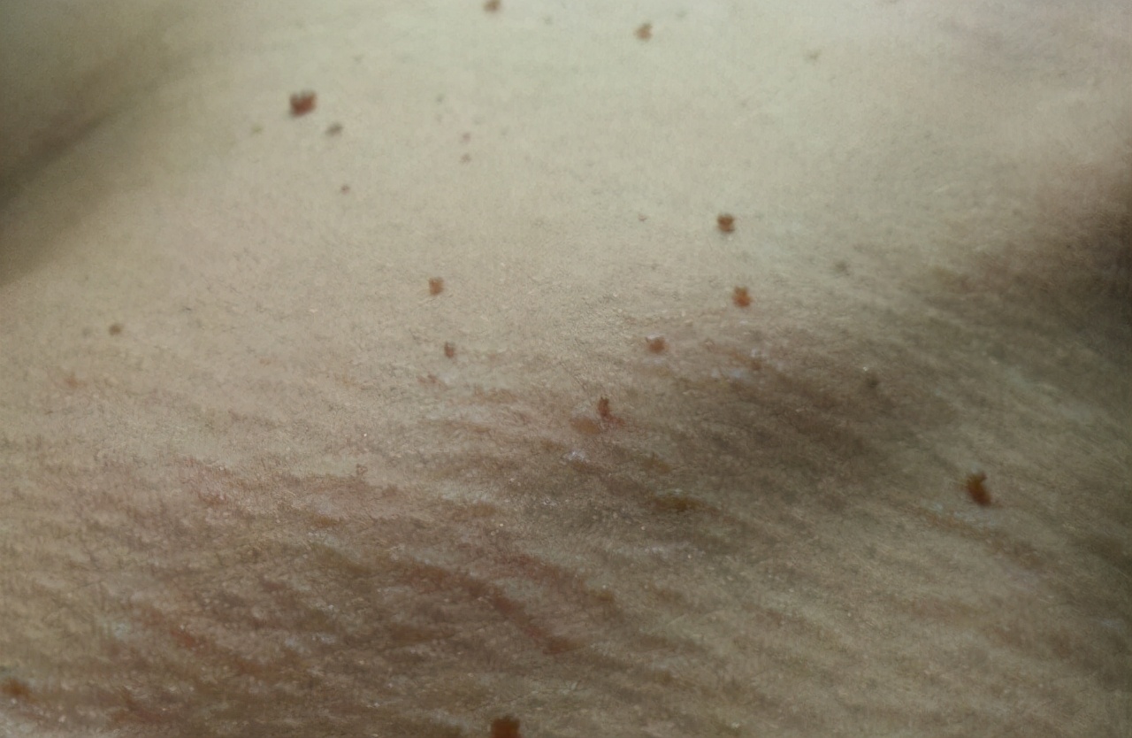 脖子和胳肢窝,脖子两侧胳肢窝有细肉怎么办